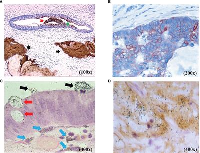 Survival Advantage Following TAG-72 Antigen-Directed Cancer Surgery in Patients With Colorectal Carcinoma: Proposed Mechanisms of Action